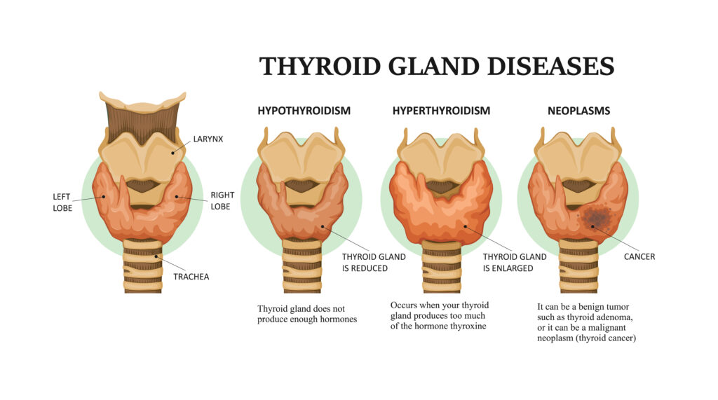 Thyroid health